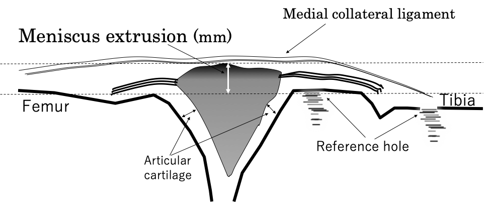 Meniscus extrusion and collateral ligament