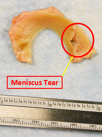 meniscus tear