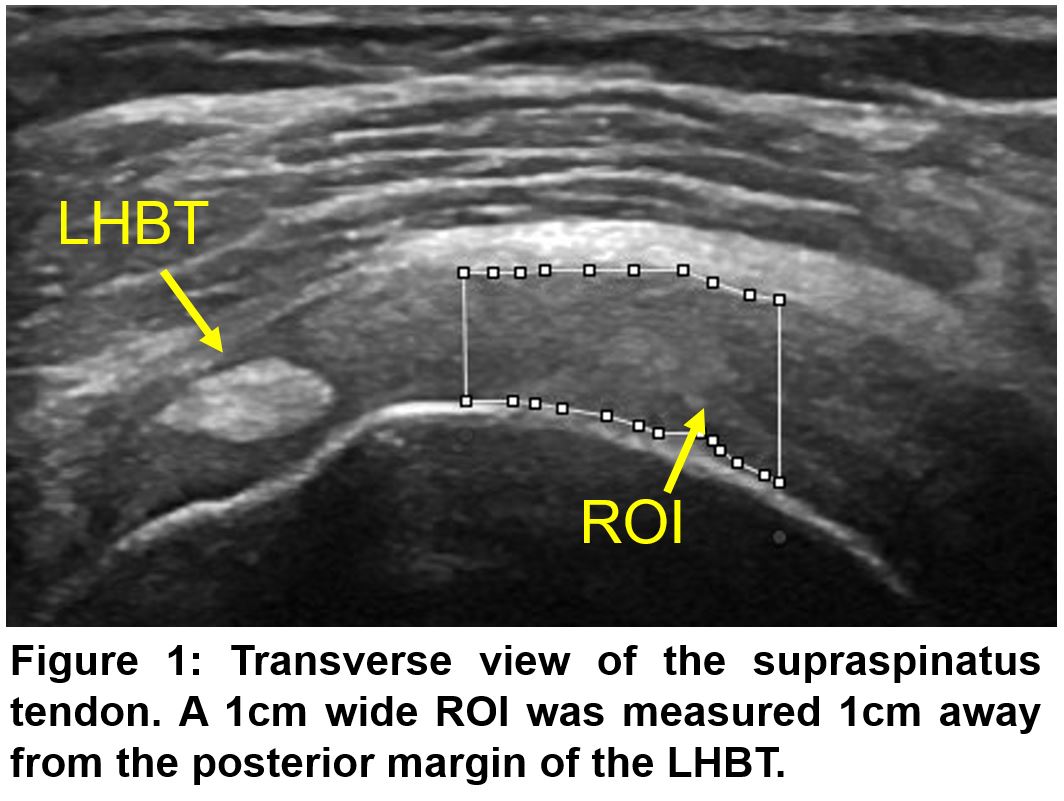 USDegen supraspinatus tendon