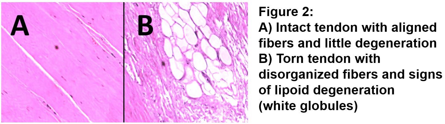 USDegen tendon