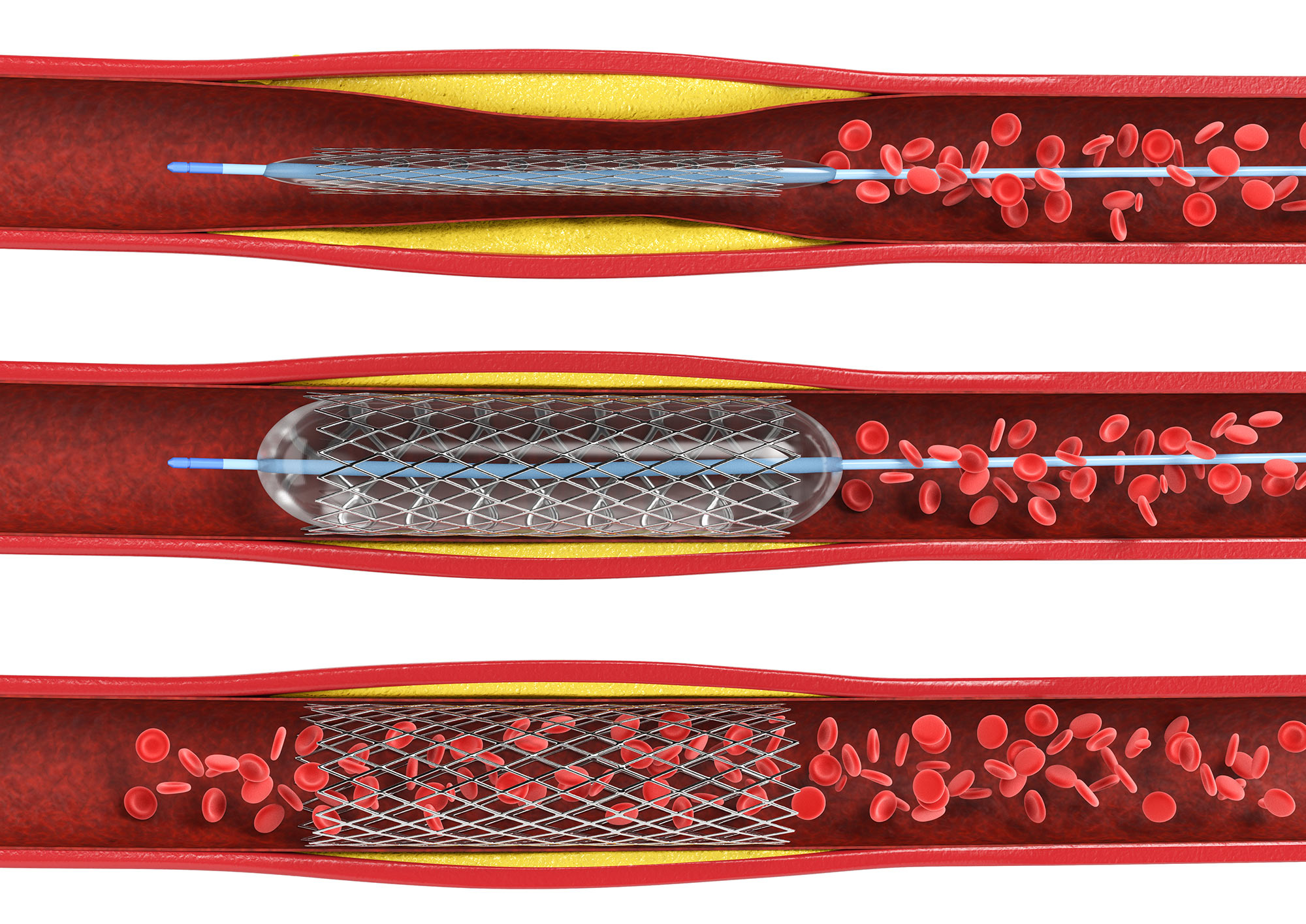 Diagram of stents