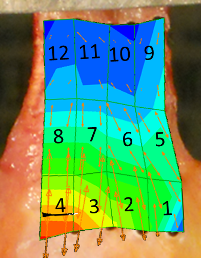 tendon strain