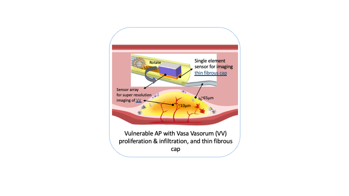 a diagram of vulnerable AP with Vasa Vasorum proliferation and infiltration and thin fibrous cap