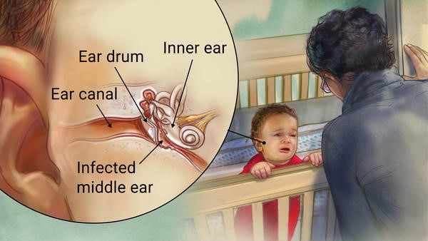 Diagram of an ear infection