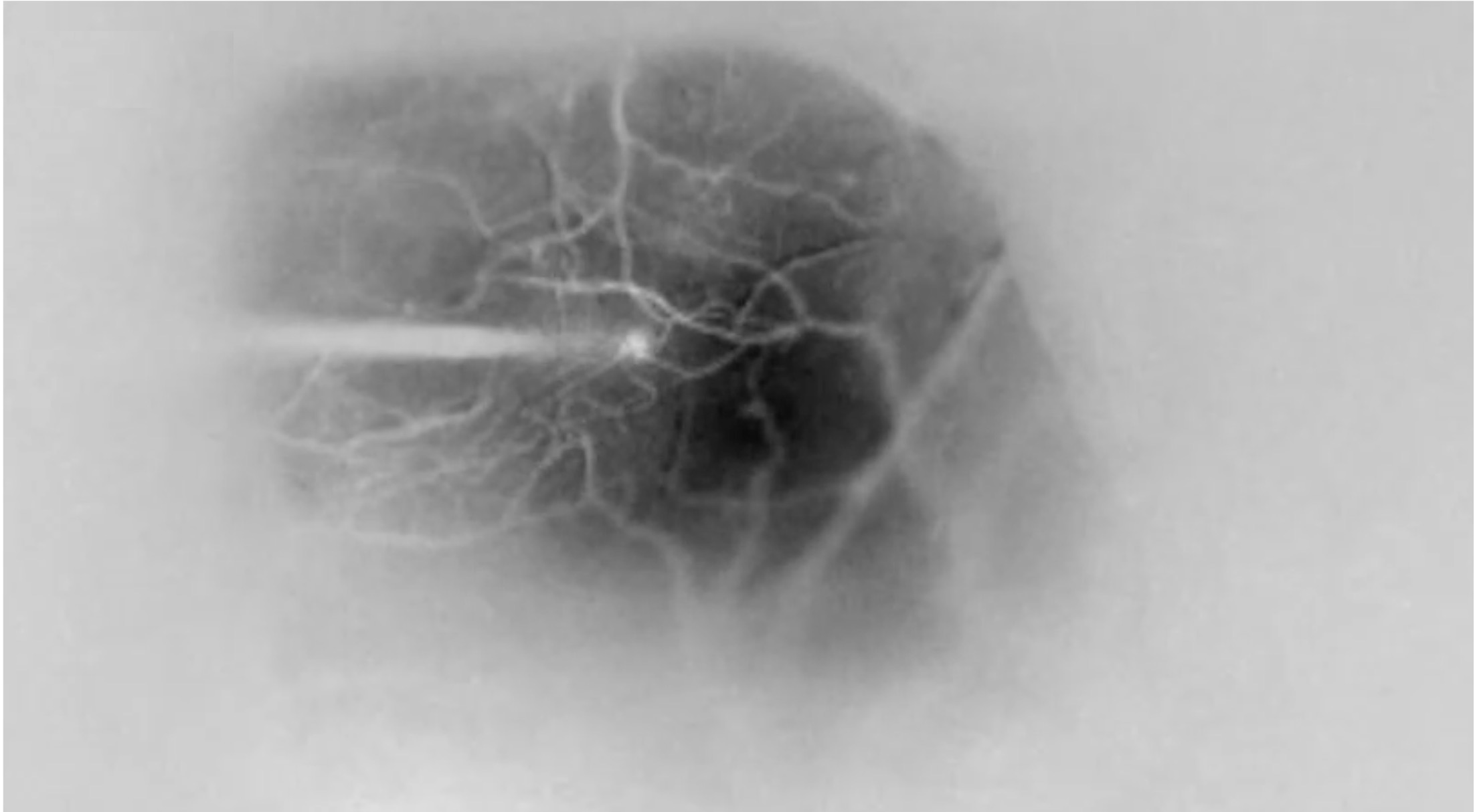 electrical stimulation via chronically implanted microelectrode arrays